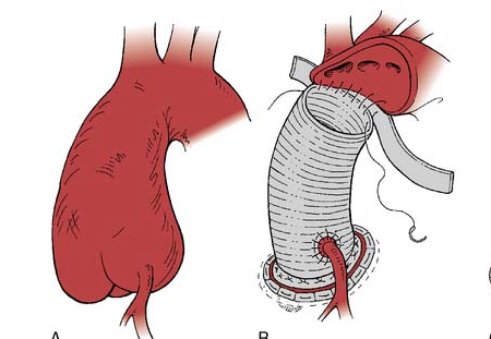 aort-koku-bentall-ameliyati
