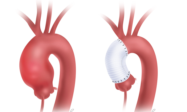 cikan-aort-anevrizmasi-ameliyati